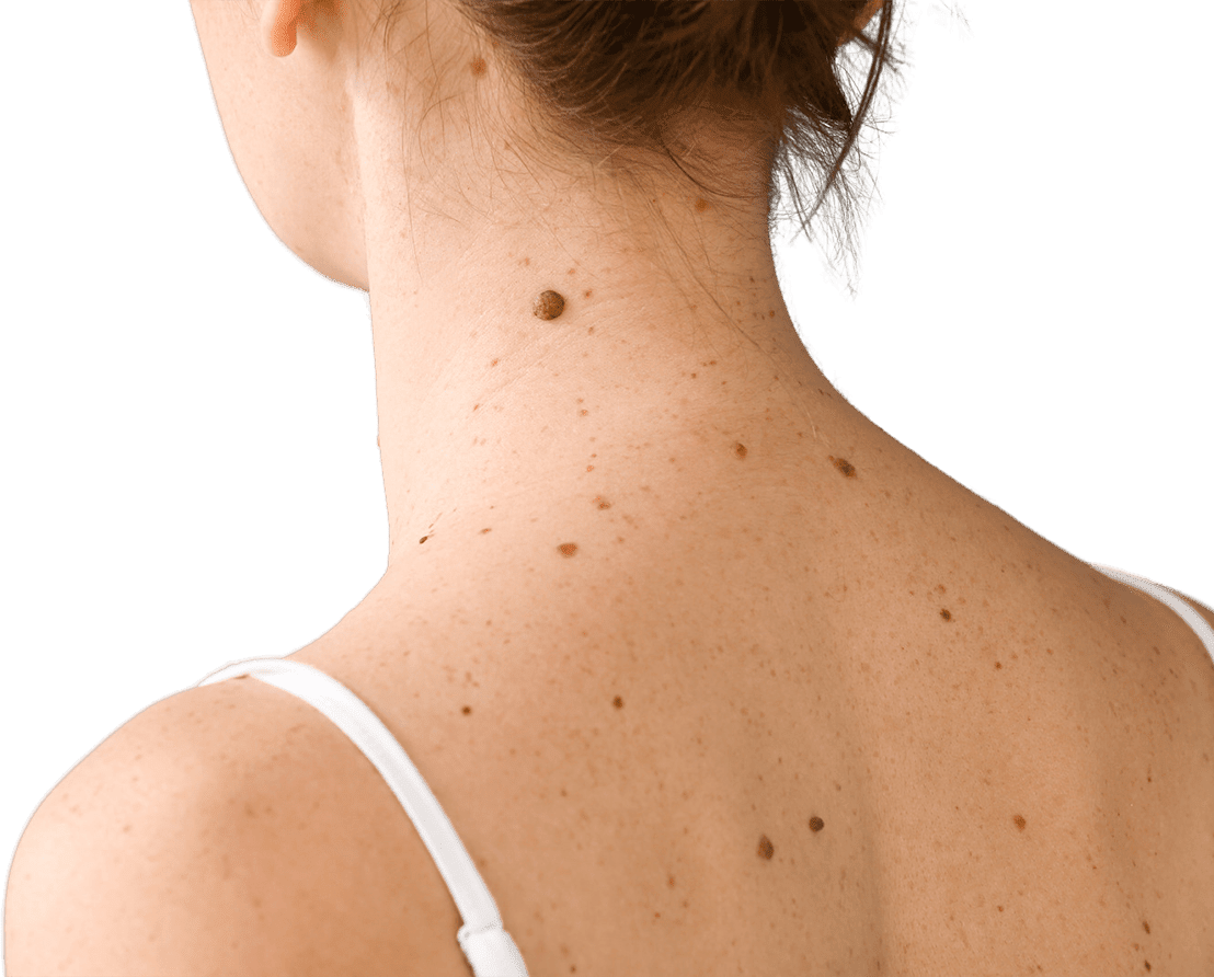 Moles